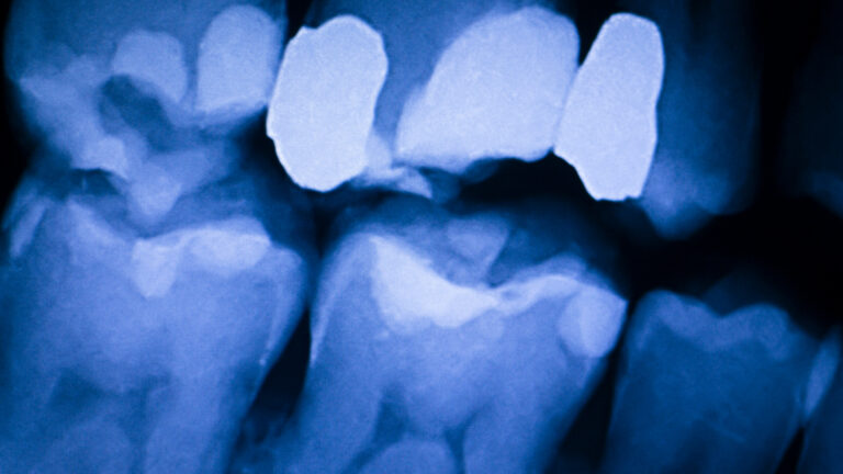 x-ray of teeth for chewing