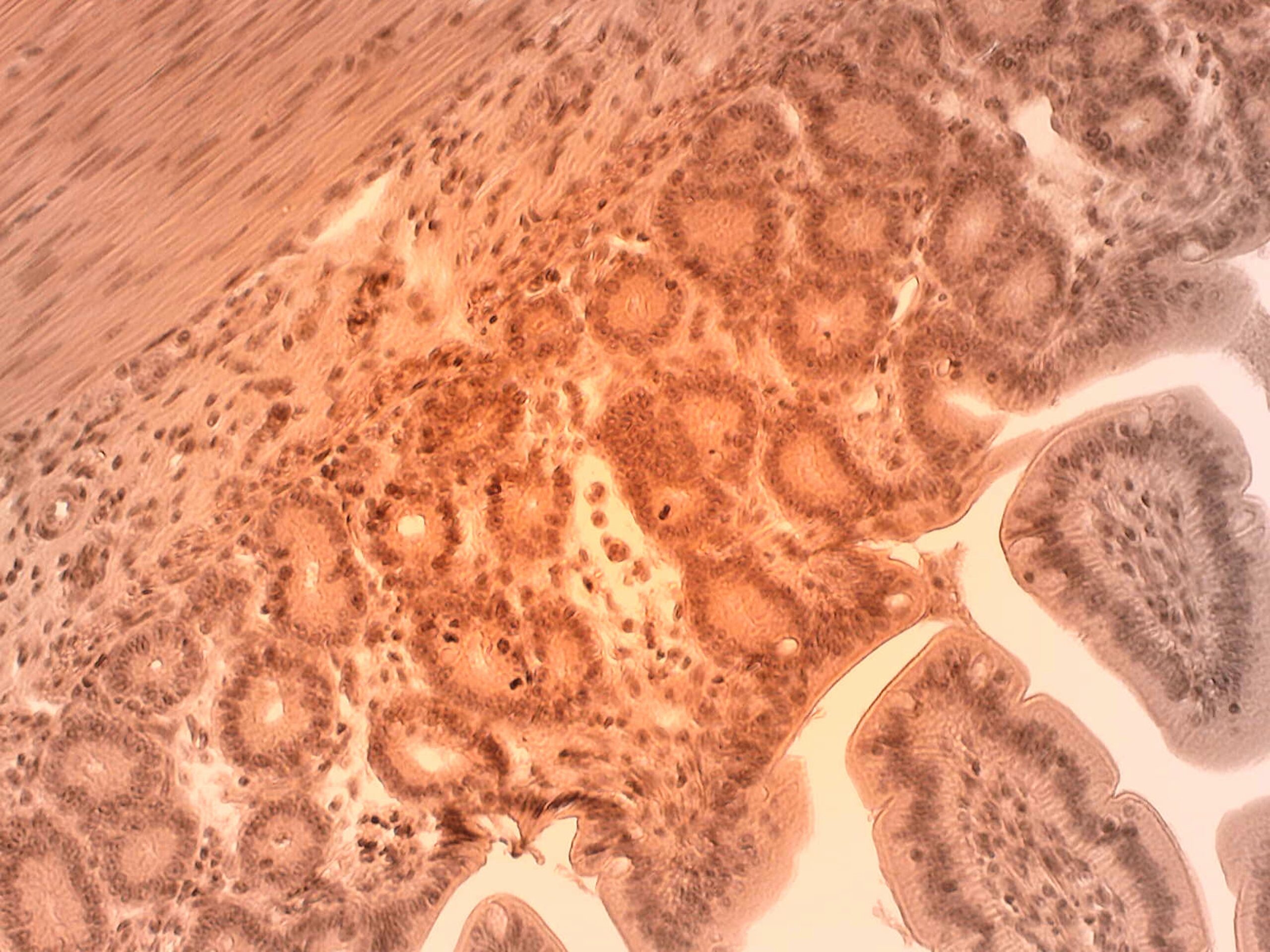 Crohn's Functional